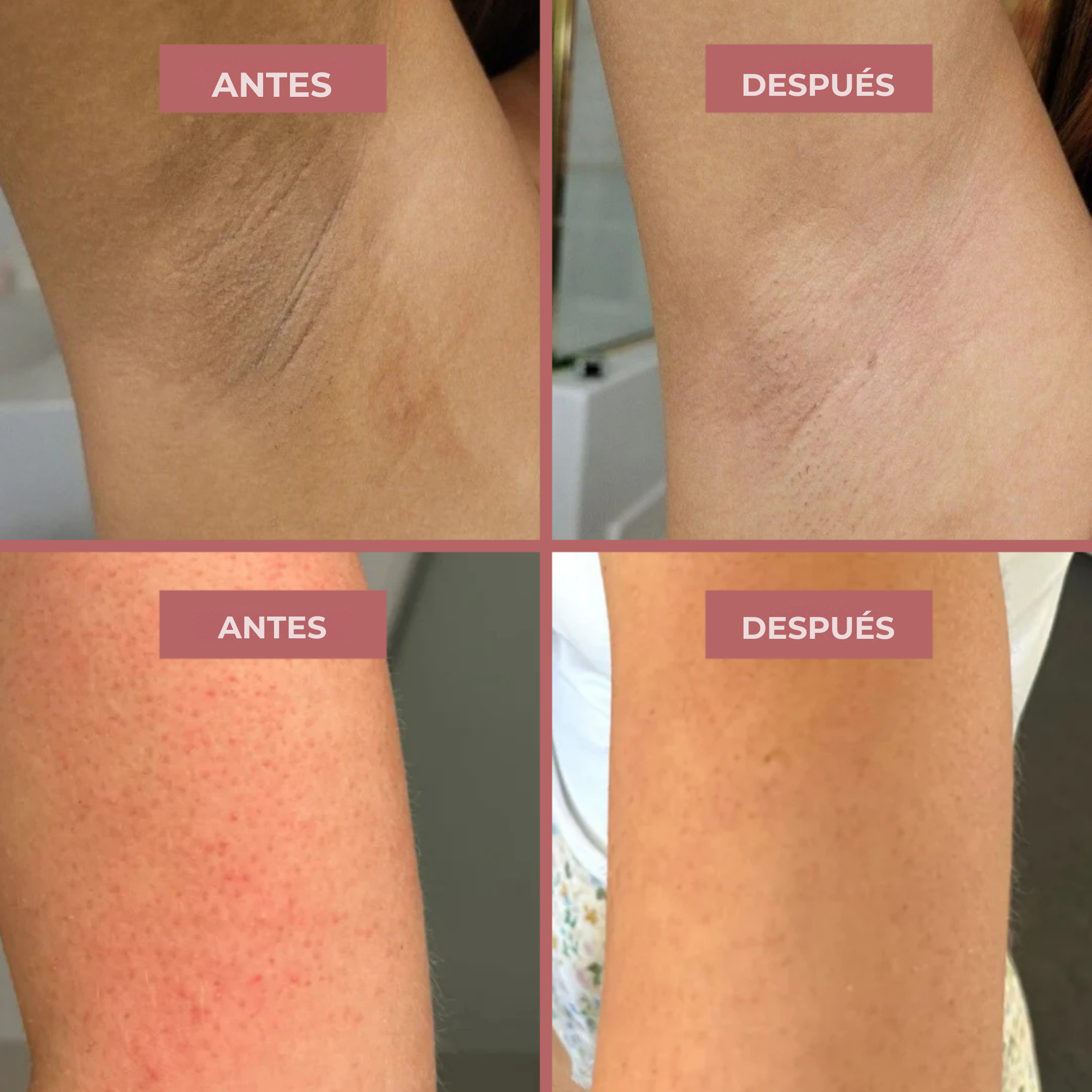 Spray esfoliante corpo - Acido Kojico + Curcuma miniatura 6
